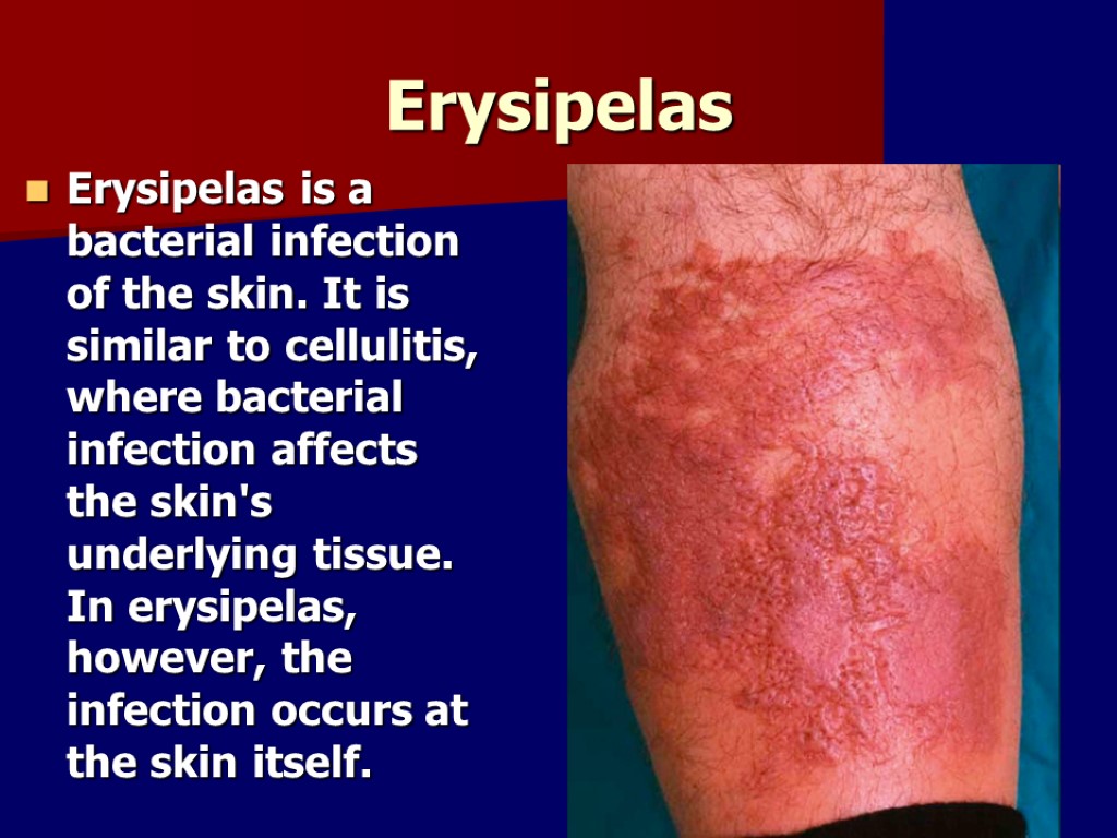 Erysipelas Erysipelas is a bacterial infection of the skin. It is similar to cellulitis,